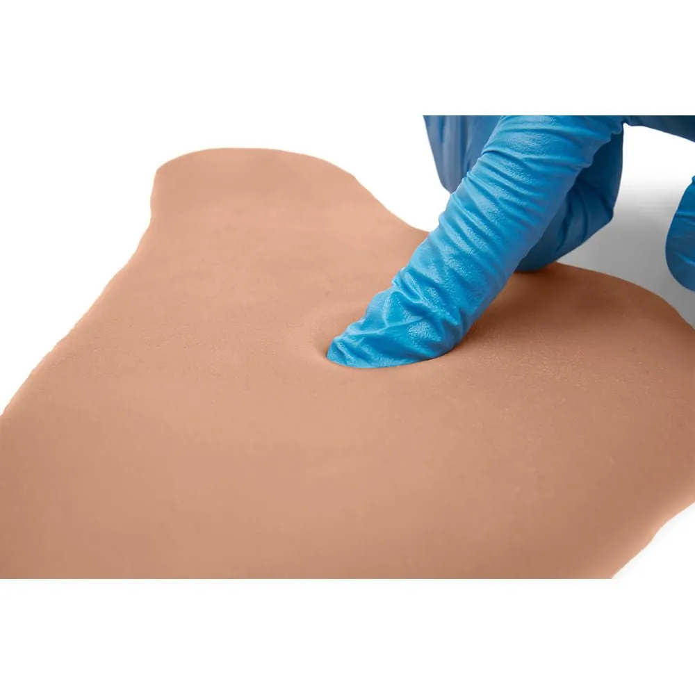 Pair Of Sticky Pitting Edema